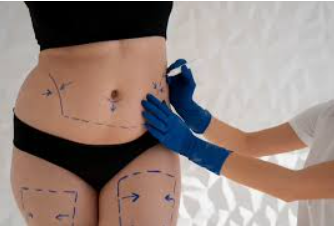 Como Garantir a Cobertura de Todas as Cirurgias Plásticas Reparadoras Pelo Plano de Saúde