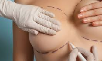 O Que Fazer Se o Plano de Saúde Negou Sua Mamoplastia?